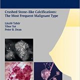 (eBook PDF)Breast Cancer - Early Detection with Mammography e, 1e  by Laszlo Tabar (Author, Series Editor), Tibor Tot , Peter B. Dean
